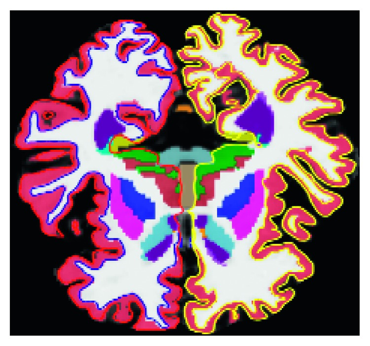 Alzheimer's Disease Diagnosis Based on Cortical and Subcortical Features
